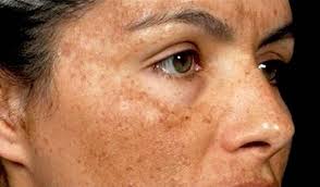 hyperpigmentation