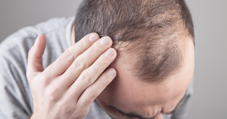 male pattern baldness